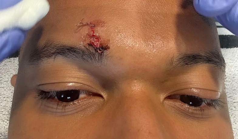 Mbappé pokazał zszyty łuk brwiowy