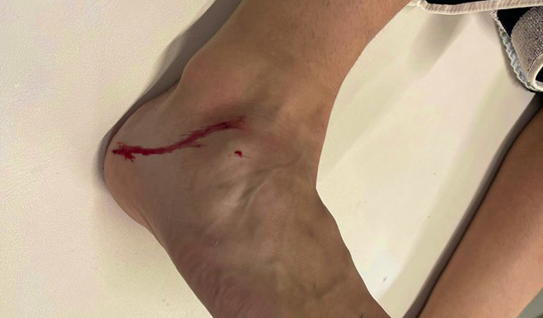 Foto: Ceballos pokazuje zranioną kostkę i odpowiada na atak Acuñi