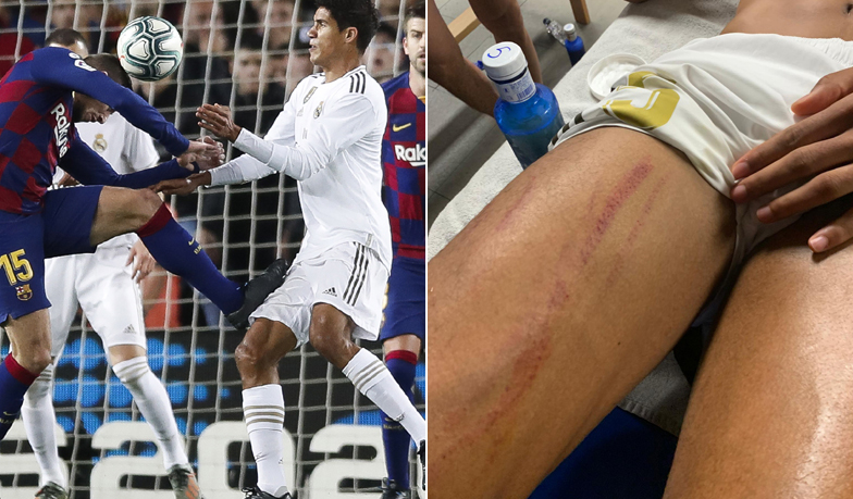 Foto: RMTV: Ten sam sędzia VAR nie widział jako VAR faulu w tych korkach w udzie Varane'a